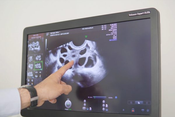 ICSI Sarajevo – intracitoplazmatska injekcija spermatozoida u IVF centru Mehmedbašić